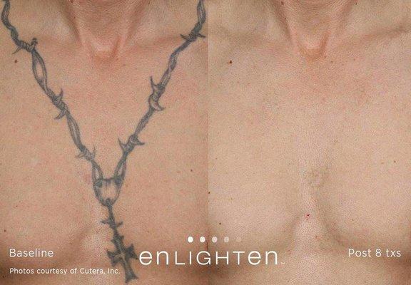 Laser Tattoo Removal NYC - Before & After