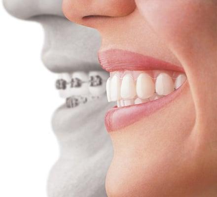 NOW YOU CAN GO WIRELESS WITH INVISALIGN