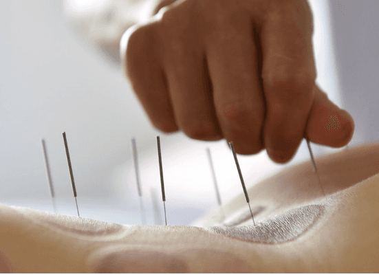 Acupuncture for chronic pain relief, as well as pain from recent injuries like car accidents.