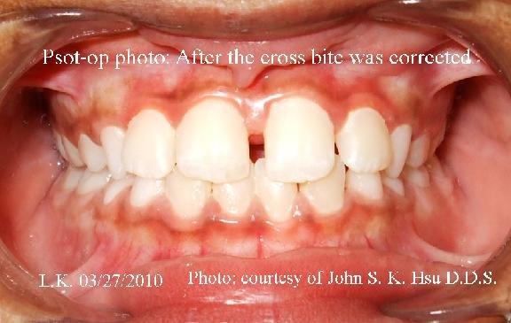 Anterior crossbite corrected-after