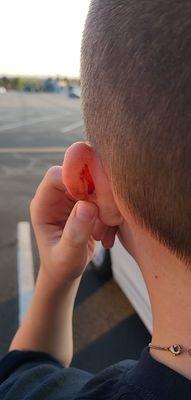 My bleeding ear