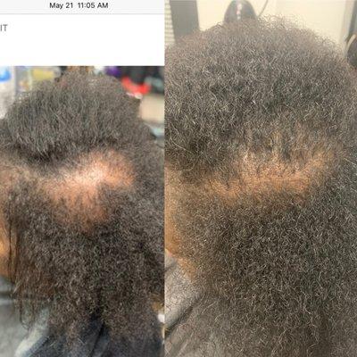 Ex. BEFORE and AFTER Pics 
 scalp & Hair treatments