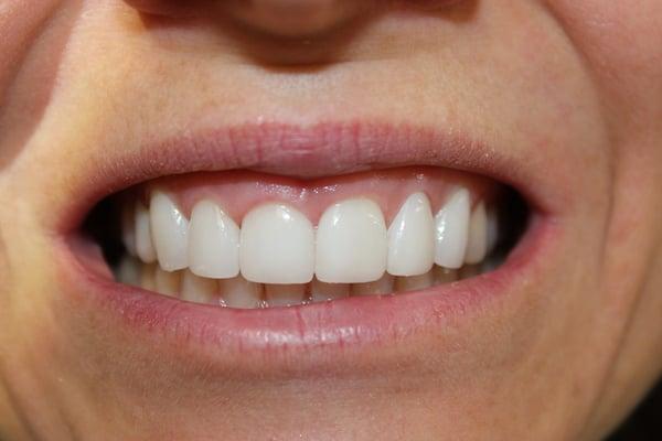 After replacing veneers