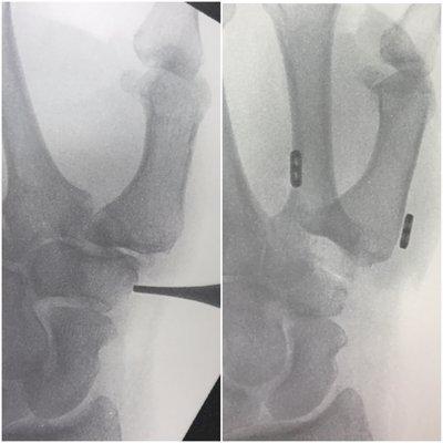 Trapeziectomy and tightrope suspension for thumb arthritis