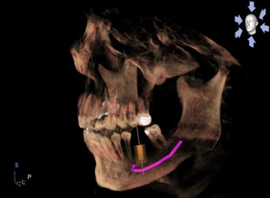 3D Imaging for precise dental implant planning.