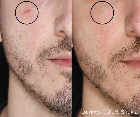 Lumecca IPL Treatment