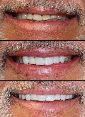 Veneers and Crowns