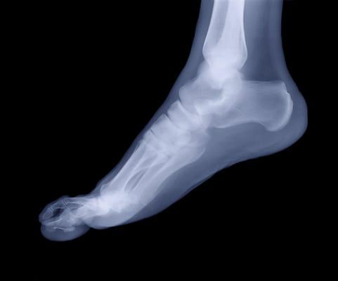 We treat heel pain from plantar fasciitis and many other causes