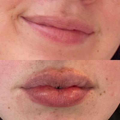 Before and After Lip Filler