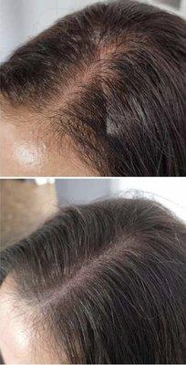 Hairline restoration, creates more fuller hair by  way of a cosmetic tattoo. Also known as micro scalp pigmentation.