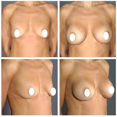 Bilateral breast augmentation