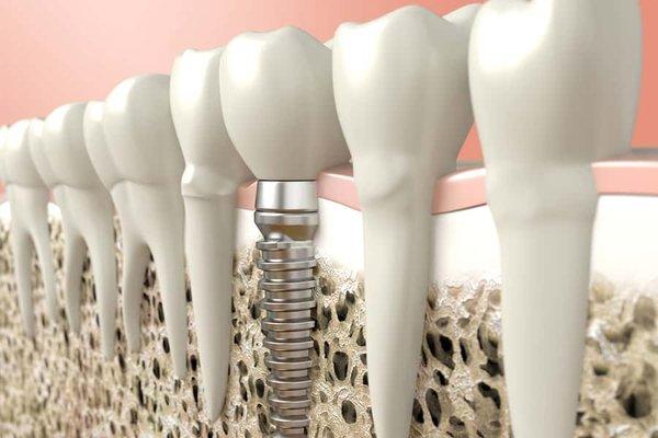 Dental Implant