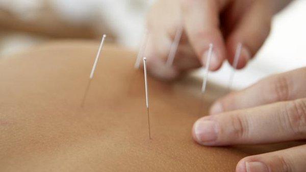 Todd Mccloskey Acupuncture