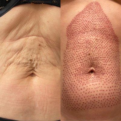 Plasma Tummy Tightening and Lifting Treatment/Technique