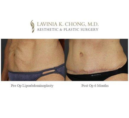 Los Angeles, San Diego, & Orange County women, are you looking for help with a stubborn belly? Newport Beach Abdominoplasty 949-644-1400!