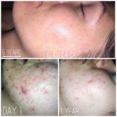 She was pregnant in the first photo. Stayed consistent with home care products and facials.