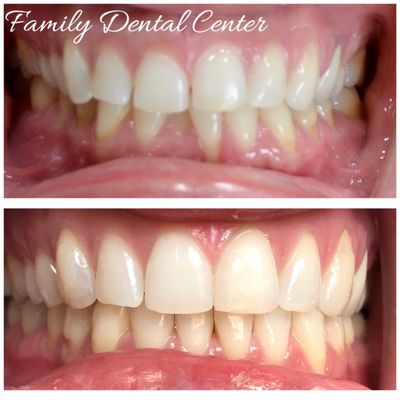 Before and after Invisalign treatment