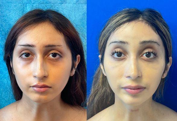 Facial Feminization