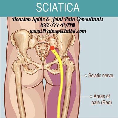 Call 832-777-PAIN ( 7246 ) and consult our Back Pain Doctor. At our Pain Management Clinic we treat Sciatica and Back Pain.