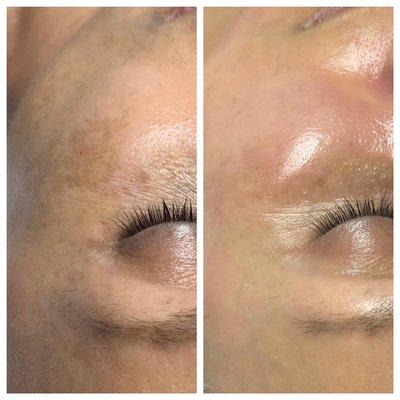 Before and After Hydrafacial with Brightening Booster.