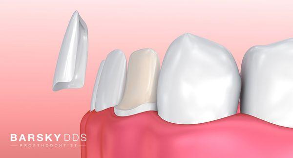 Dental Veneer placement.