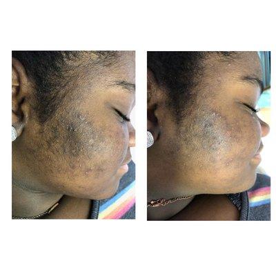 Before and after treatment