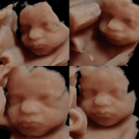 5D or HD ultrasound