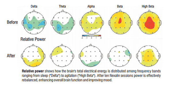 Nexalin sessions power is effectively re-balanced, enhancing overall brain function and improving mood.