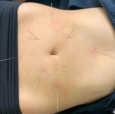 acupuncture