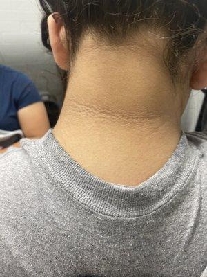 Back of the Neck; Skin Lightening Treatment