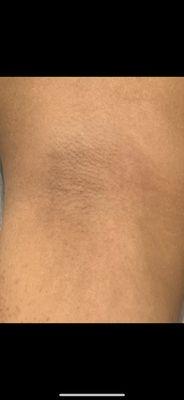 After photo of underarm sugaring hair removal. Lasts 2-3 weeks