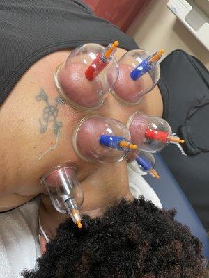 Cupping Therapy