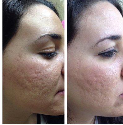 Microneedling