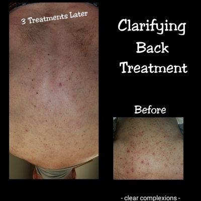 Acne Clarifying Back Treatment. With 3 treatments we cleared up 90% of his acne.