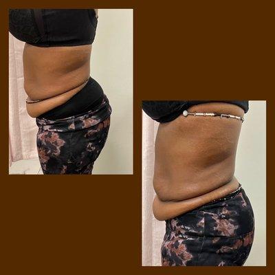 The client is reducing her waist through 360 lipo and fat reduction