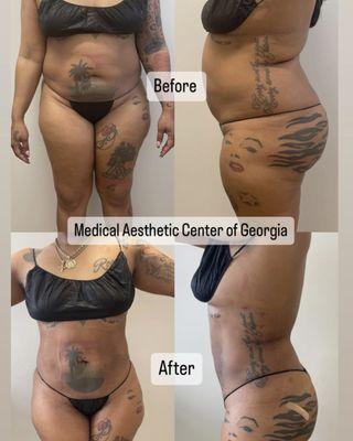 20 Days post operation for our client that under went liposuction and also continued our weight loss program for comprehensive health!