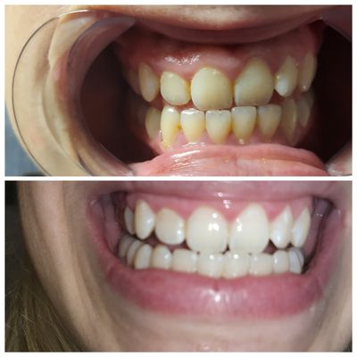 All natural teeth whitening with ZERO SENSITIVITY and INSTANT results.