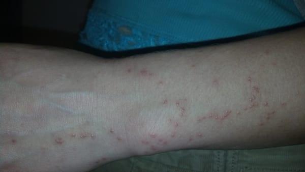 MY WIFES ARM BIT TO HELL!!!