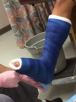 Foot cast round one!