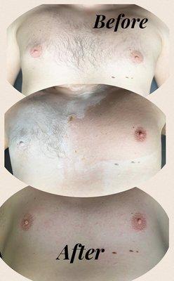 Chest Sugaring Service