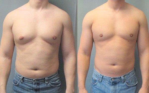 Before and After Male Slimming Session