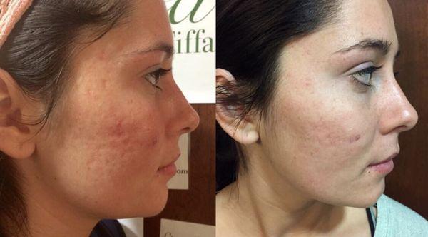 Triple transformation peel results