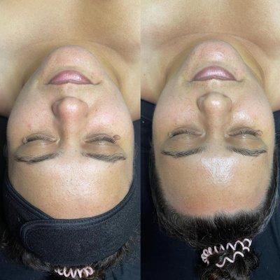 Before & After on this clients very first facial