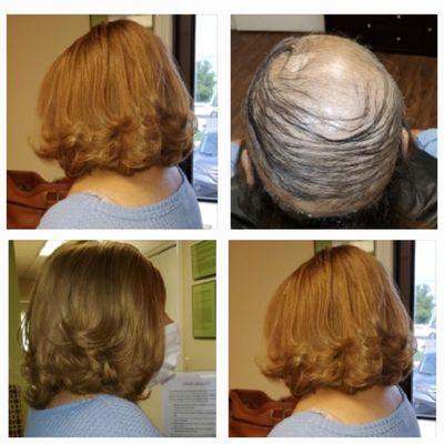 Restore Non-Surgical Hair Replacement Center