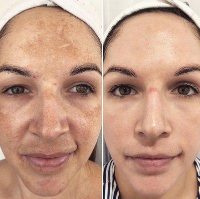 Depigmentation treatment results.