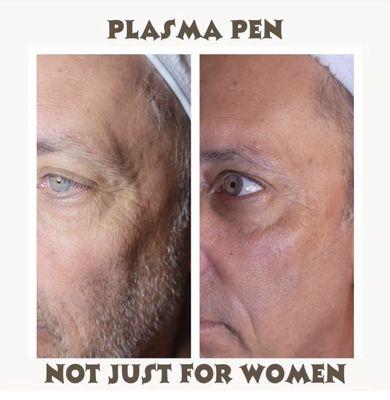 Eight treatments of jet plasma