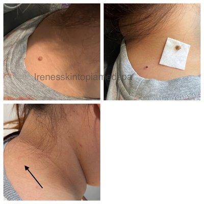 Huge Skintag removal right after and 8weeks healed(right neck)