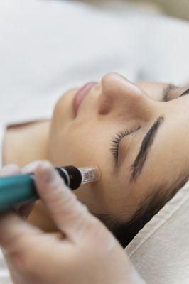 Microneedling