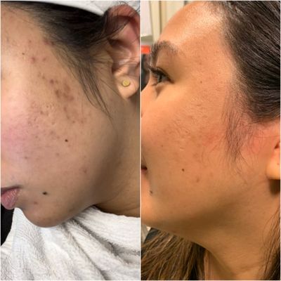 3 microneedling with PRP (4-6weeks apart)