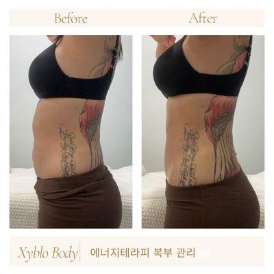 Hifu Body Contour